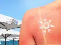 Oparzenia słoneczne jak szybko wyleczyć? Krem na czerwonej skórze, przypominający słońce, na tle plaży.