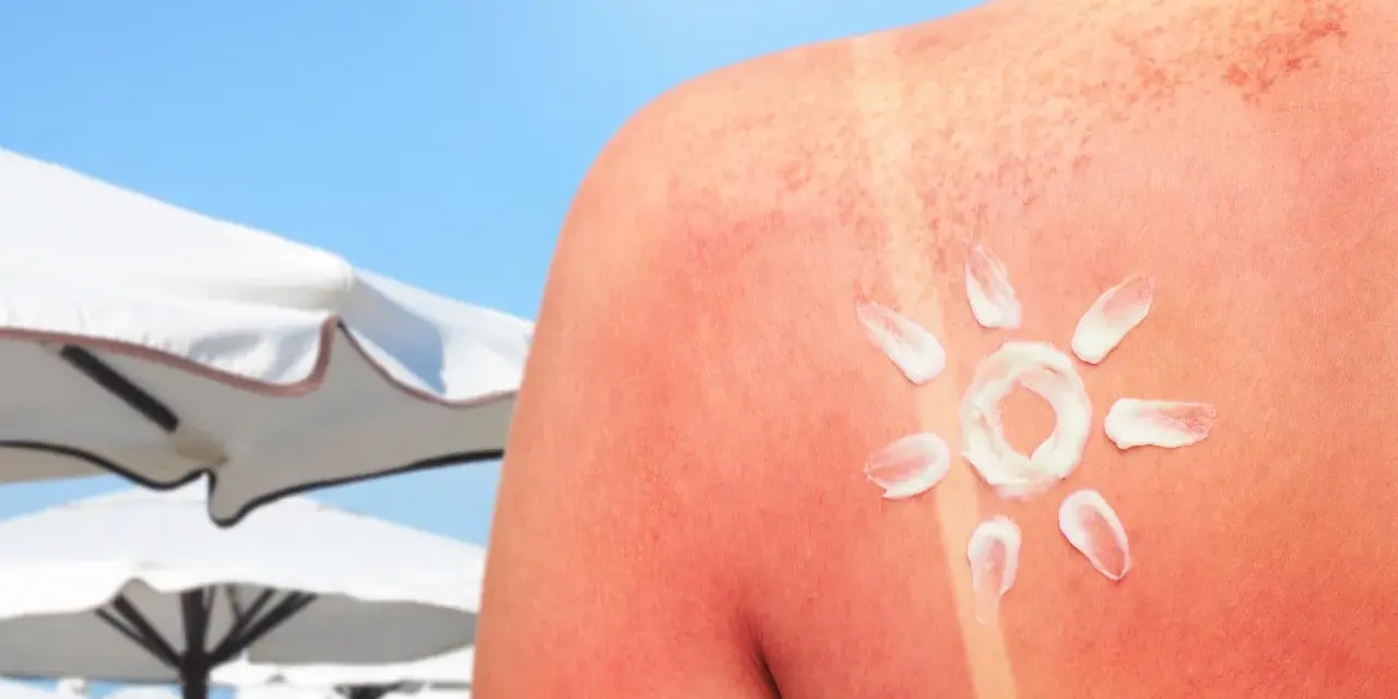Oparzenia słoneczne jak szybko wyleczyć? Krem na czerwonej skórze, przypominający słońce, na tle plaży.