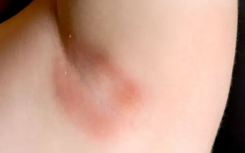 Czerwona wysypka pod pachami, która może być objawem podrażnienia lub alergii. Skóra jest zaczerwieniona i lekko spuchnięta.