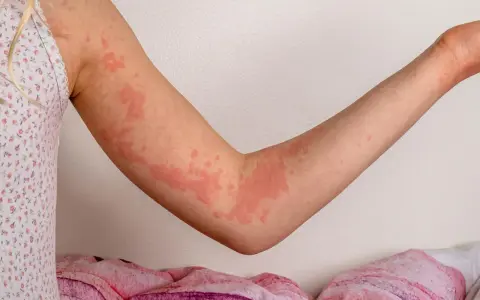 Ręka dziecka pokryta zaczerwienionymi bąblami, objaw wysypki alergicznej pokarmowej.