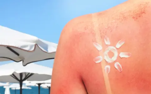 Oparzenia słoneczne jak szybko wyleczyć? Krem na czerwonej skórze, przypominający słońce, na tle plaży.