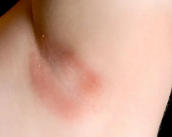 Czerwona wysypka pod pachami, która może być objawem podrażnienia lub alergii. Skóra jest zaczerwieniona i lekko spuchnięta.