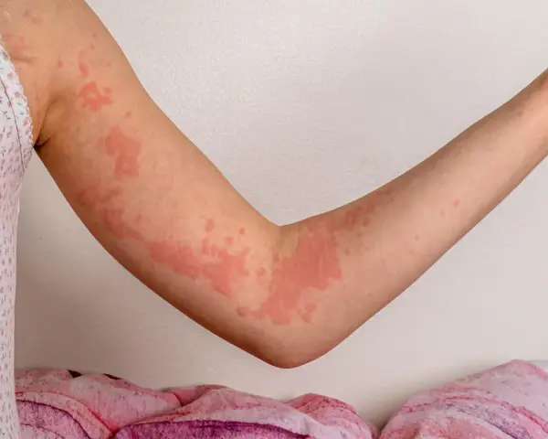 Ręka dziecka pokryta zaczerwienionymi bąblami, objaw wysypki alergicznej pokarmowej.