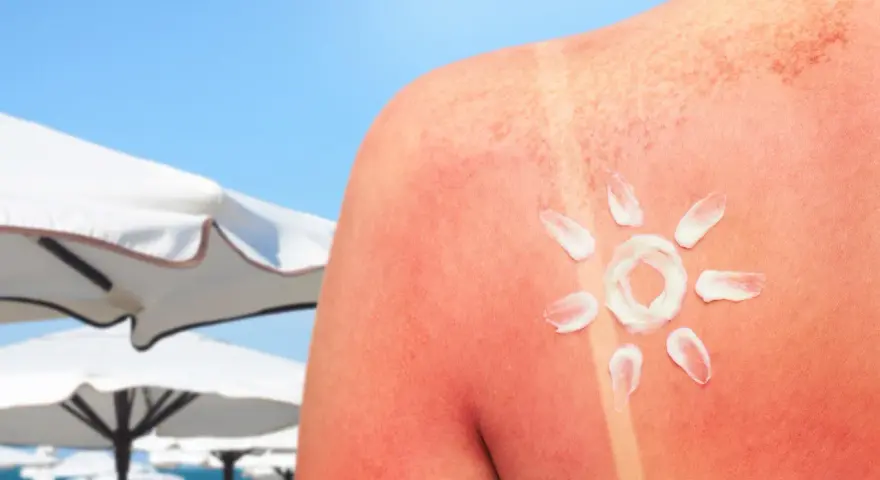 Oparzenia słoneczne jak szybko wyleczyć? Krem na czerwonej skórze, przypominający słońce, na tle plaży.