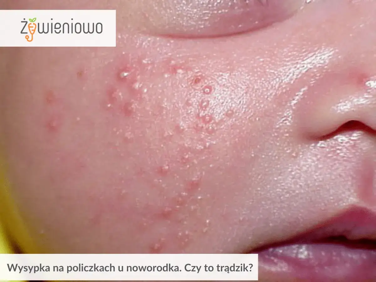 Delikatna wysypka kaszka na policzkach niemowlaka. Czy to trądzik niemowlęcy?